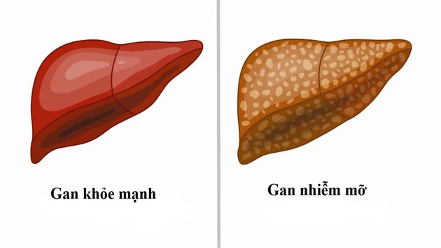 Dược phẩm tuệ tĩnh chia sẽ cách điều trị gan nhiễm mớ an toàn