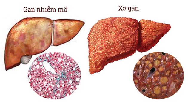 Dược phẩm tuệ tĩnh chia sẽ các hiểu biết về gan nhiễm mỡ 