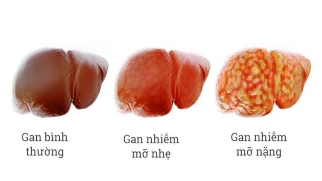 Hiểu rõ bệnh gan nhiễm mỡ không do rượu bia