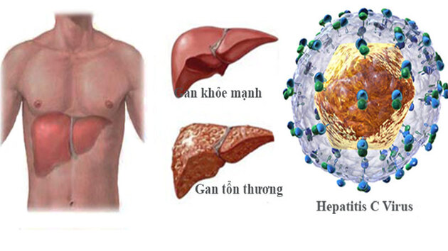 Chuyên gia chia sẽ nguyên nhân và cách điều trị gan mạn 