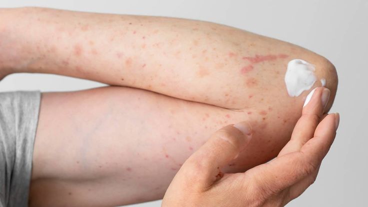 Sẩn ngứa do gan, nguyên nhân và phương pháp điều trị