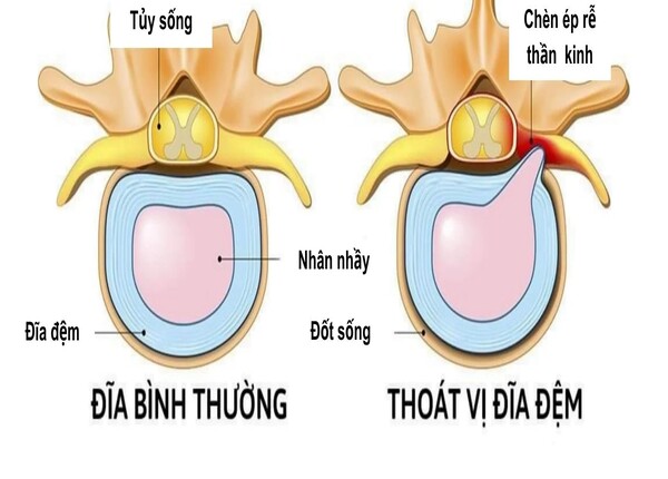 Thoát vị đĩa đệm: Nguyên nhân, dấu hiệu nhận biết?