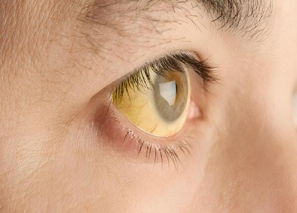 Mắt bị vàng: 5 Nguyên nhân bạn không nên bỏ qua? 