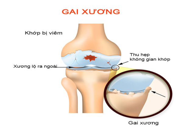 Gai xương: Nguyên nhân và những thông tin cần biết?
