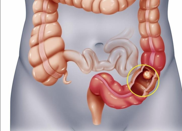 Ung thư đại tràng có lây không? Dấu hiệu nhận biết sớm